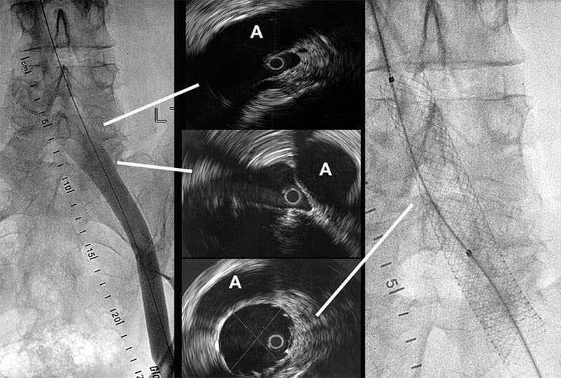 Intravascular Ultrasound Assessment