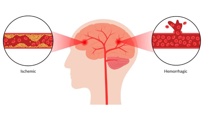 Cerebrovascular Diseases chart