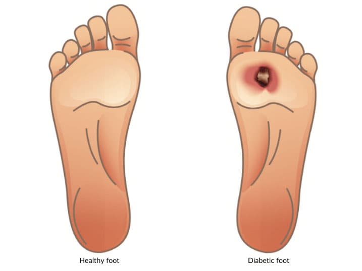 Diabetic Foot