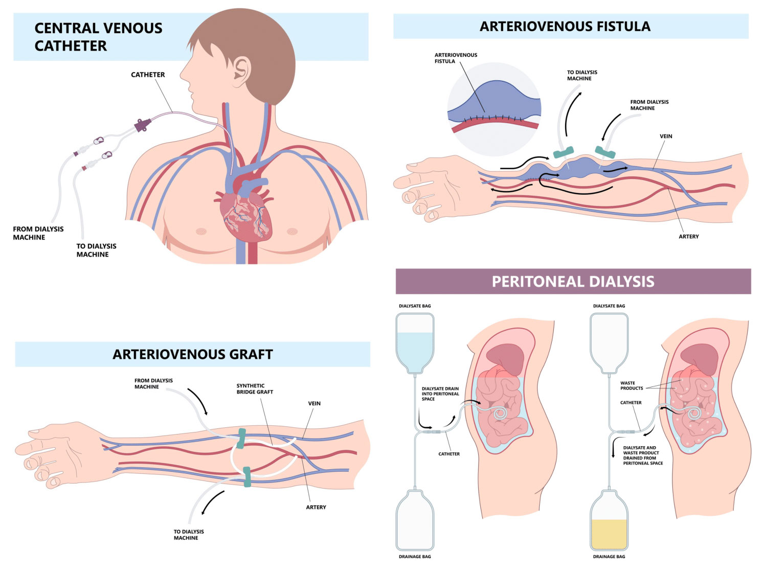Dialysis Access1