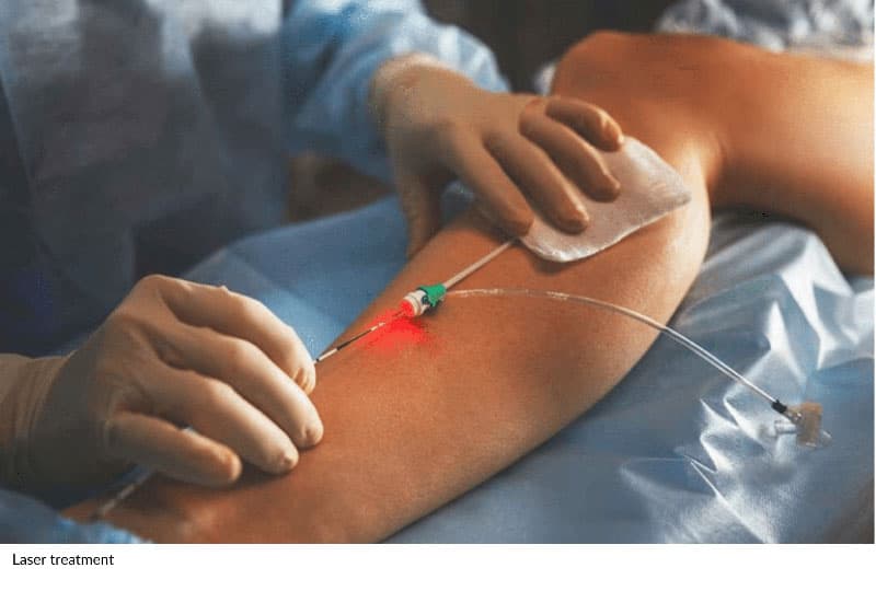 Laser Treatment