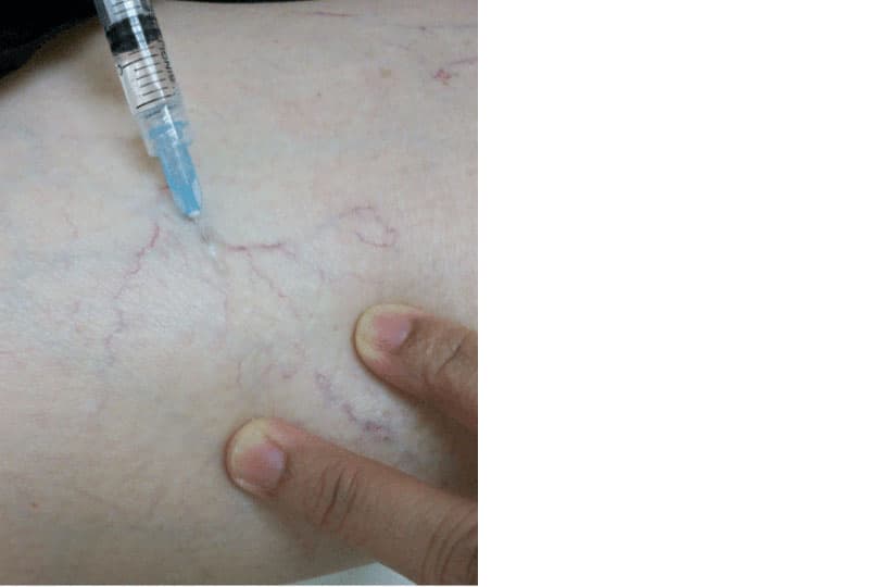 Microsclerotherapy