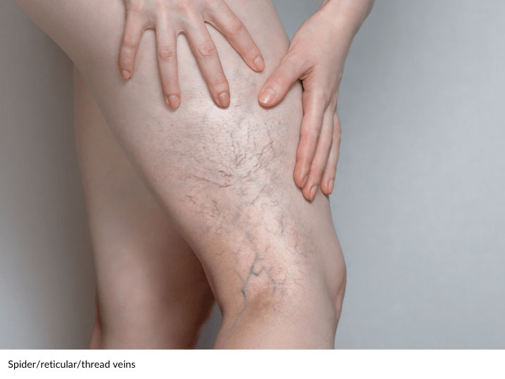 varicose veins