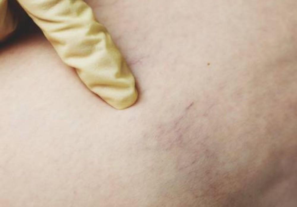 Understanding Your Vein Health