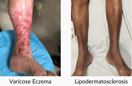 Venous Disease cases