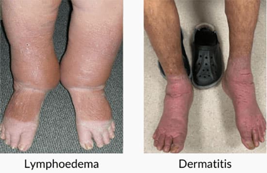 Venous Disease cases 2