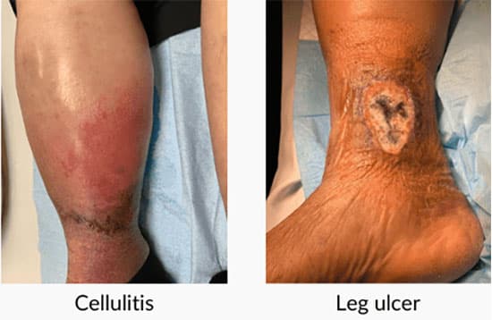 Venous Disease cases 3