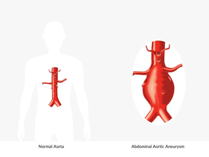 aortic chart
