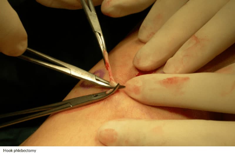 hook phlebectomy