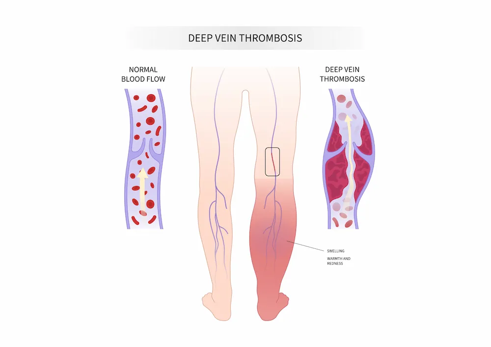 Image of DVT vs normal blood flow