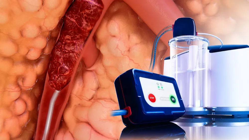 An illustration of mechanical thrombectomy procedure