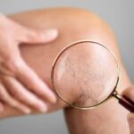 Prevent spider veins