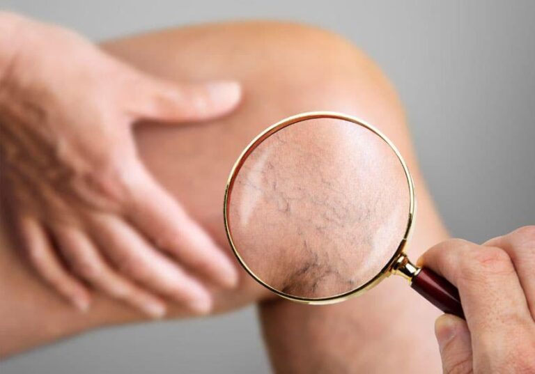 Prevent spider veins