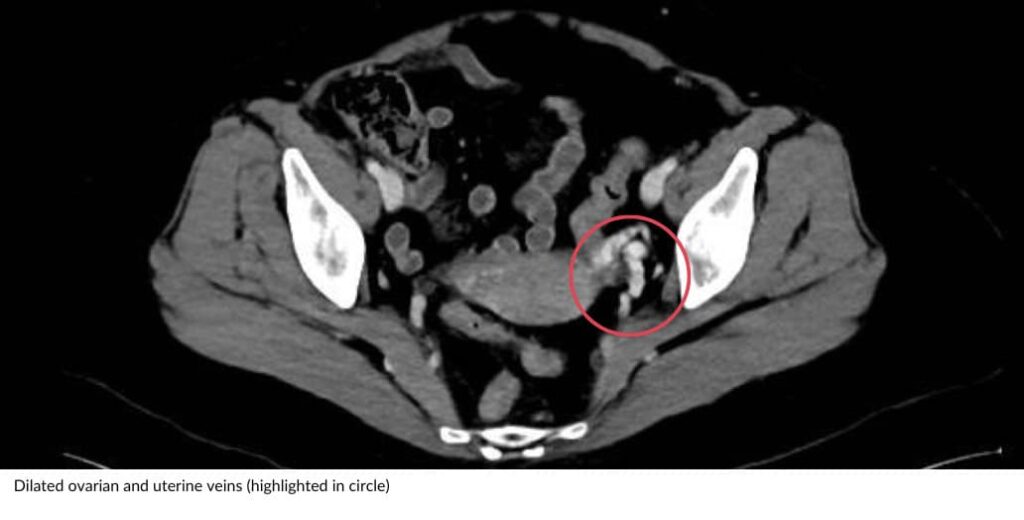 Dilated ovarian veins