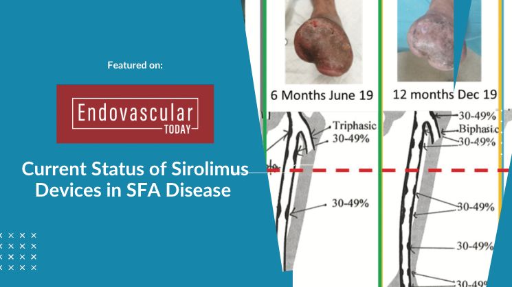 current status of sirolimus devices