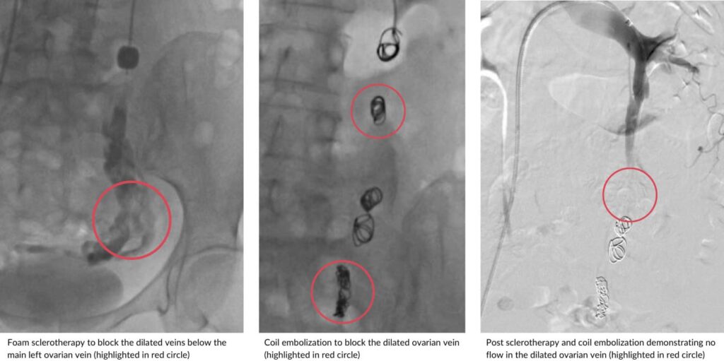 Pelvic congestion syndrome