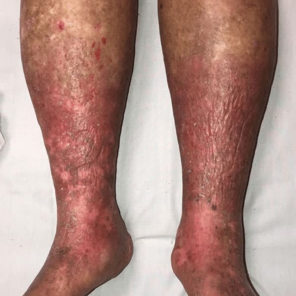 Cellulitis Example Case