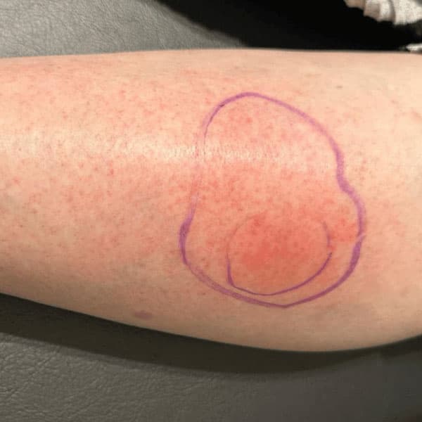 Cellulitis Example Case