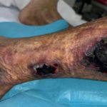 Diabetic Foot Ulcers