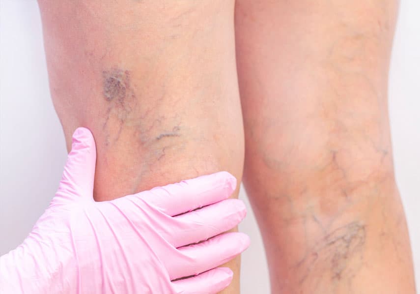 Spider and Thread Veins