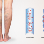 Suction Thrombectomy for Deep Vein Thrombosis