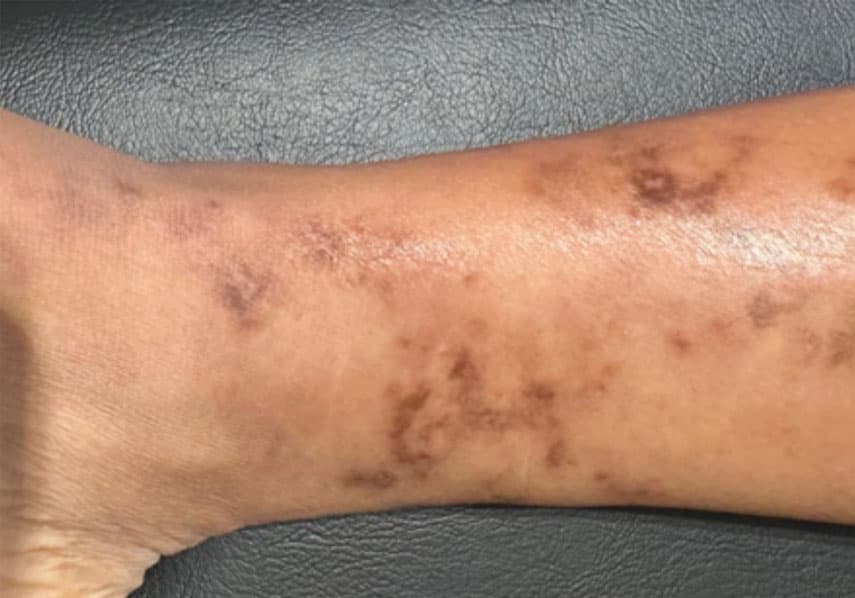 Understanding Vasculitis