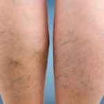 varicose veins