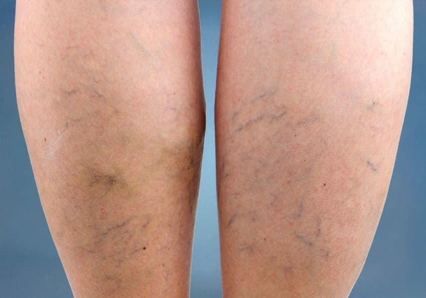 varicose veins