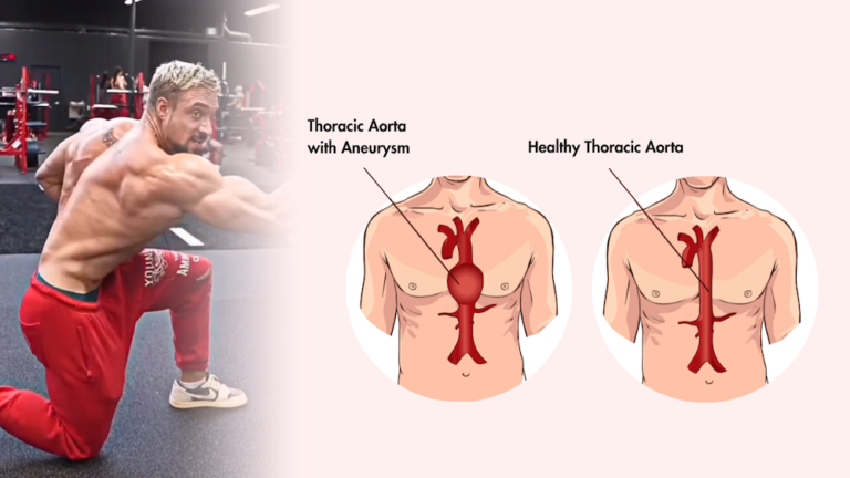 Aneurysm in Singapore - VEC