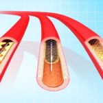 Angioplasty Procedure