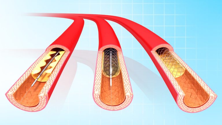 Angioplasty Procedure