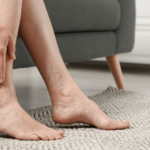 Chronic Venous Insufficiency Symptoms