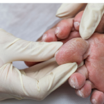 Keyhole Procedures for Diabetes