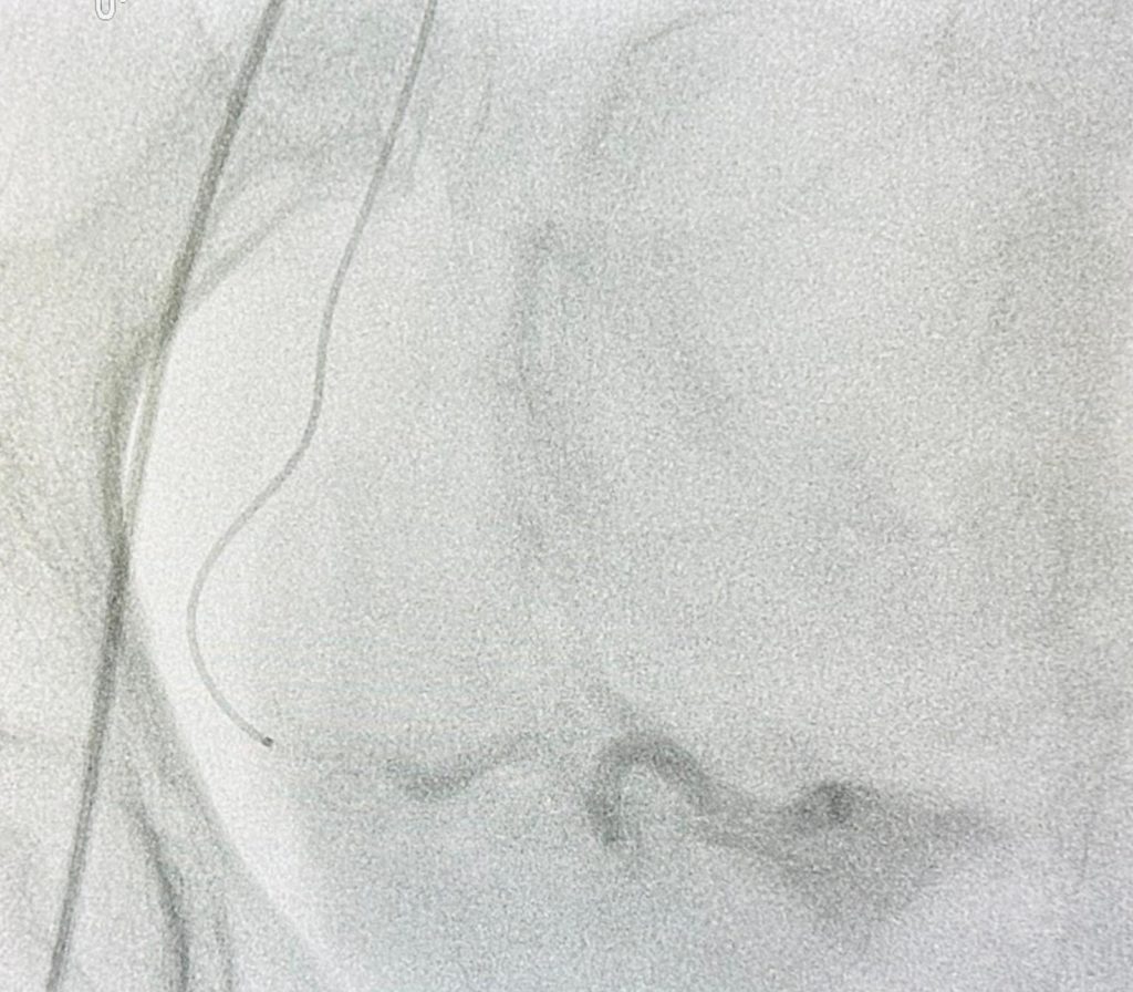 fibroids 1
