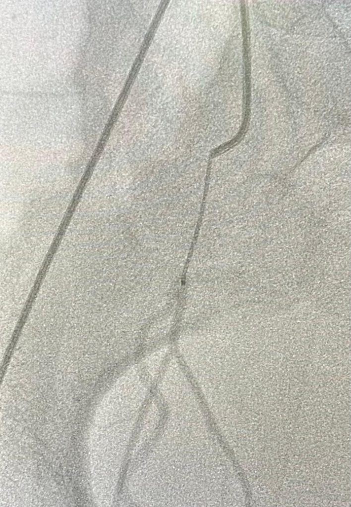 fibroids 2