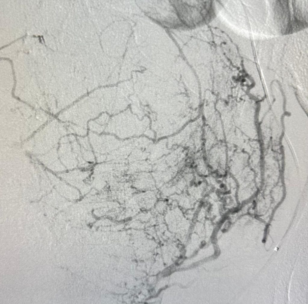 fibroids 3