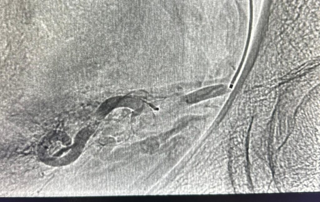 fibroids 4