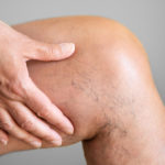 Varicose Vein Surgery Recovery