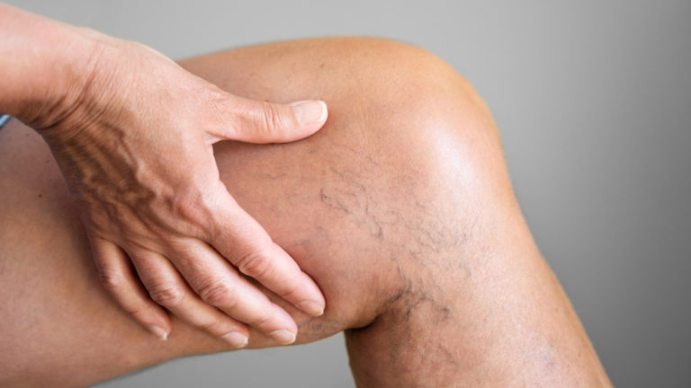 Varicose Vein Surgery Recovery