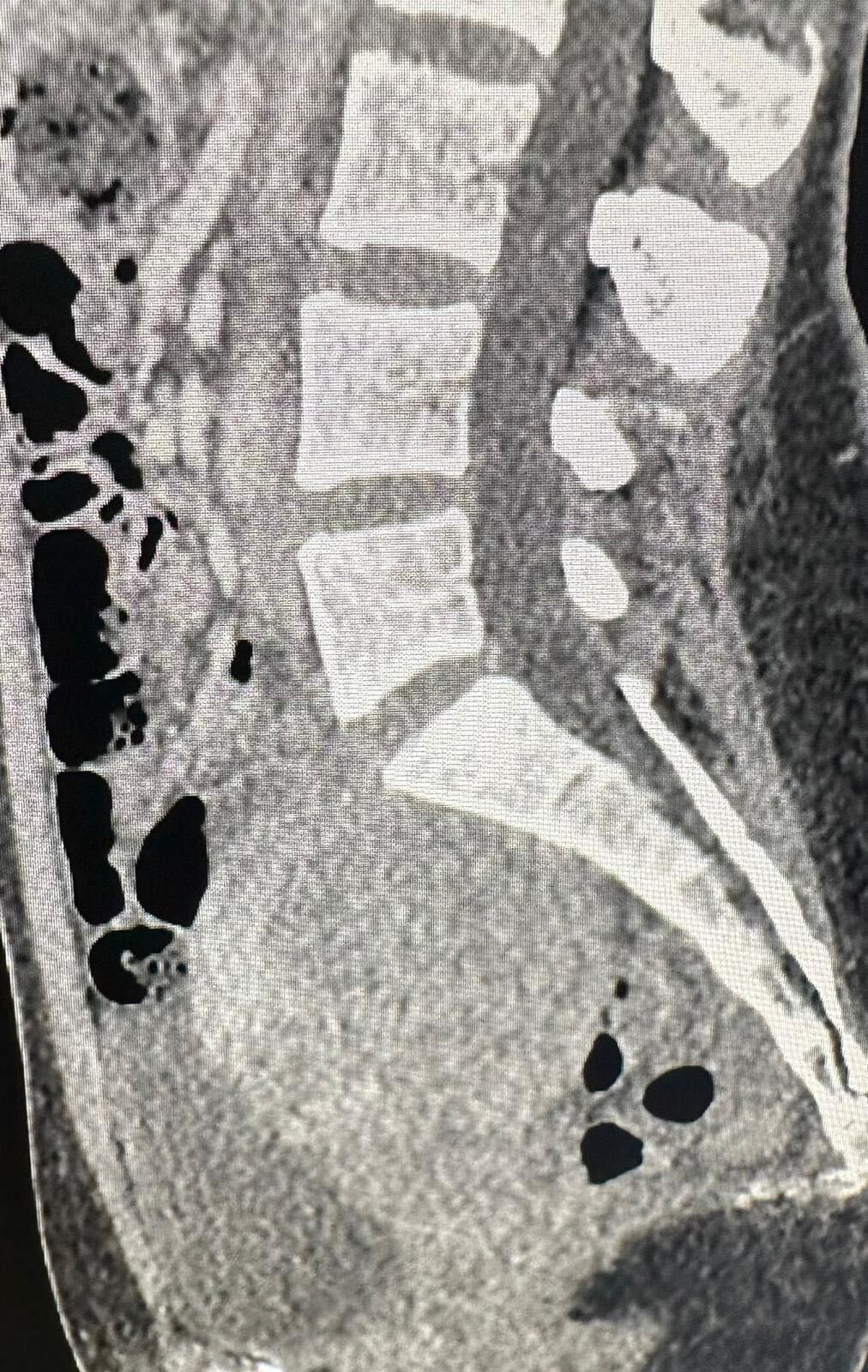 What are fibroids 2