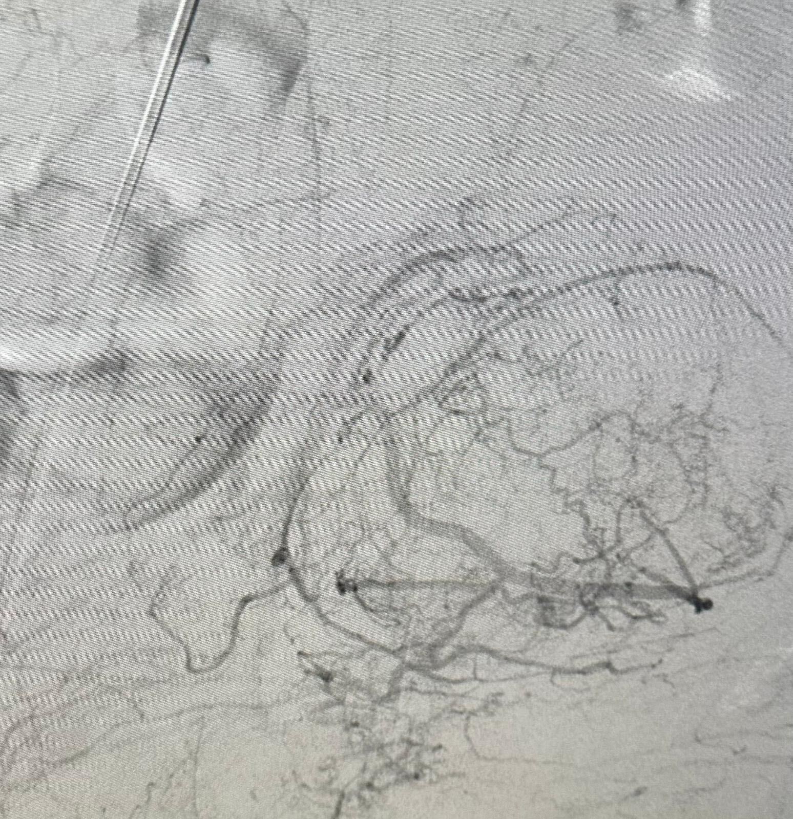 fibroids