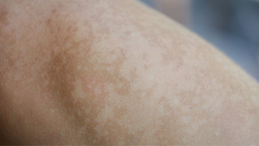 Brown Pigmentation on the Legs