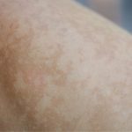Brown Pigmentation on the Legs