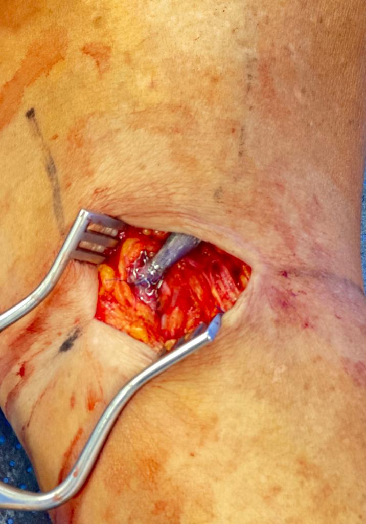 Vascular Clinic Implant procedure