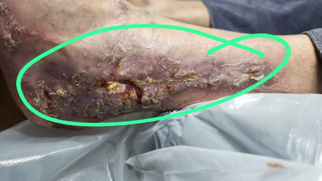 Pre wound debridement and oxygen therapy