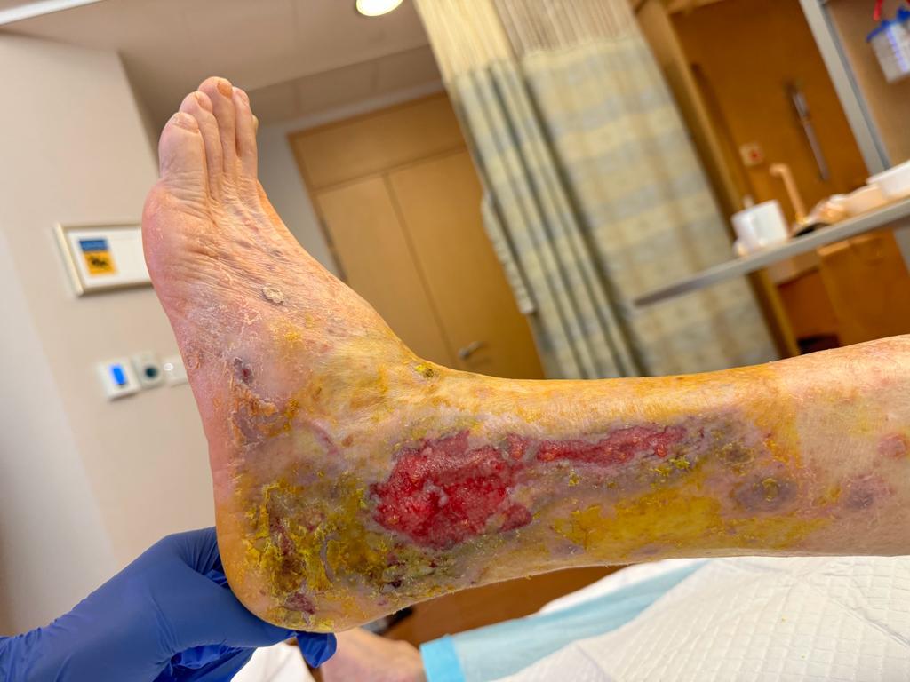 Post wound debridement, revascularization and oxygen therapy