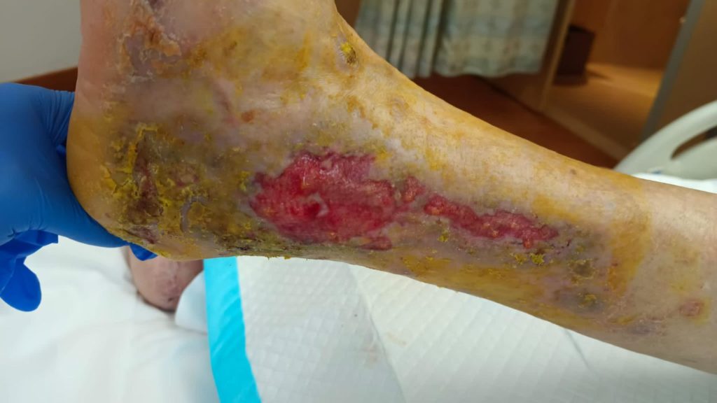 Day2 post topical oxygen therapy