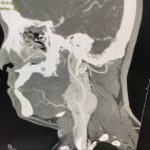 CT scan showing carotid body tumor in the neck copy