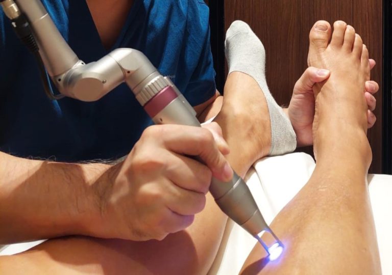 Candela Laser for Spider Veins 2