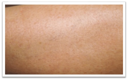 Candela laser treatment